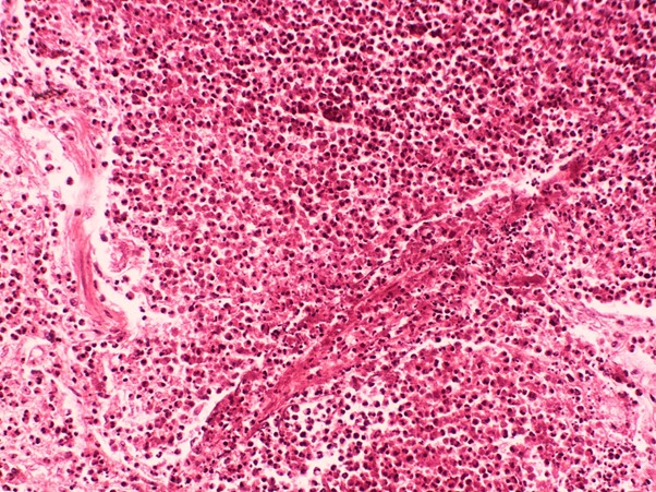 Histologische Aufnahme von Lungengewebe mit starker eosinophiler Infiltration rund um ein Blutgefäß und fibrinoider Nekrose. Die Darstellung zeigt Gewebeschäden durch hohe Eosinophilen-Werte, wie sie bei EGPA auftreten können.
