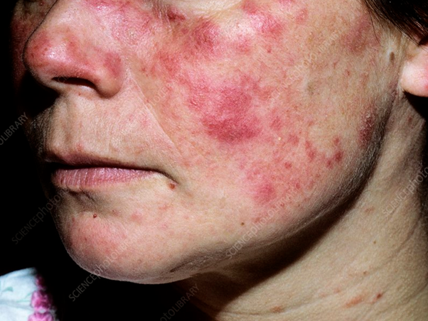 Foto einer Frau mit Ausschlag über Wangen und Nase, eines der Hauptzeichen von Lupus. 